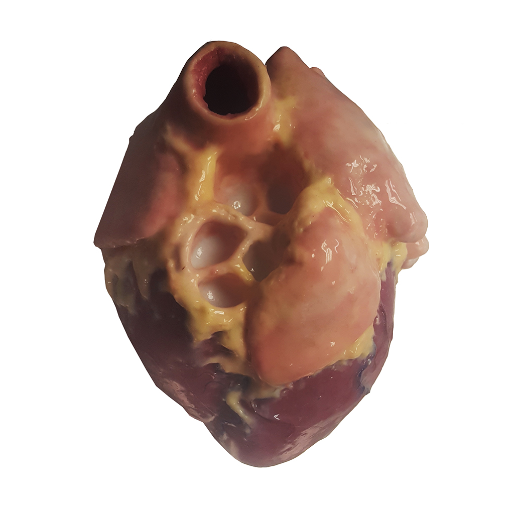 Bisected Four Chambered Heart